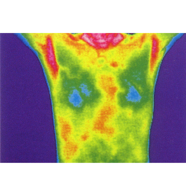   乳腺診斷

熱成像可以用來檢測乳房組織的溫度差異，由于腫瘤組織的新陳代謝通常高于正常組織，它們可能會在熱圖像上表現(xiàn)為熱斑。