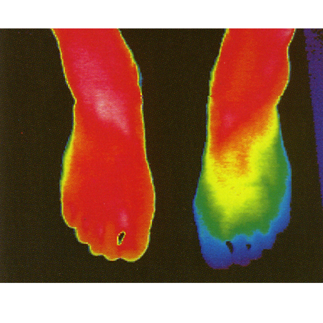   足部健康評估：

熱成像可以用來監(jiān)測糖尿病患者的足部溫度，預(yù)防足部并發(fā)癥，如潰瘍和感染。